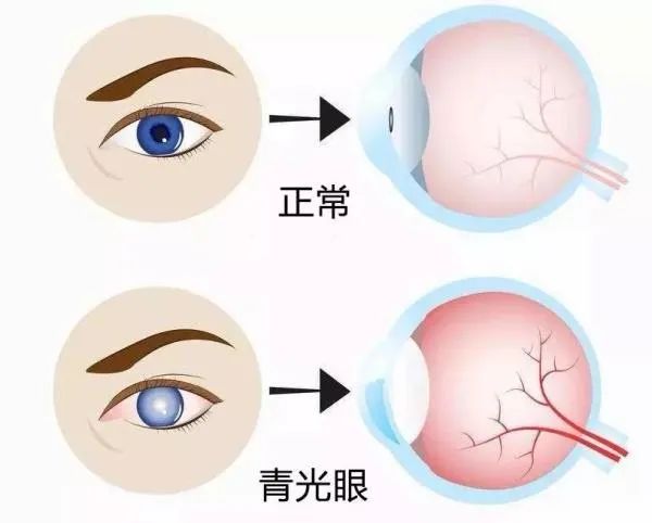 眼睛疾病（眼睛疾病一共有多少种）,眼睛疾病（眼睛疾病一共有多少种）,第1张